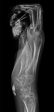 X-rays of Calcinosis of the hand and fingers in scleroderma.