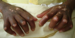 SCLERODERMA OF THE HANDS THICKENING PHASE