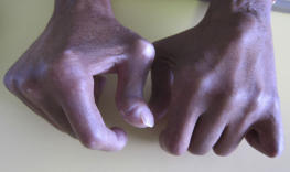 SCLERODERMA OF THE HANDS ATROPHIC PHASE