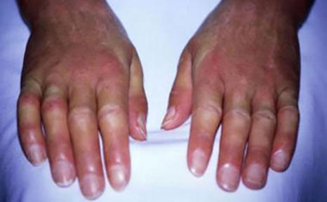 SCLERODRMA OF THE HANDS SWELLING STAGE
