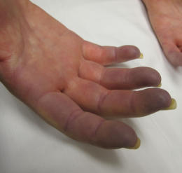 Raynaud's Stage 2 decreased oxygen - blue fingers