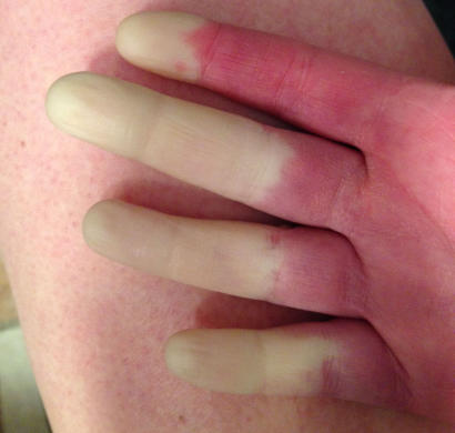 Raynaud's stage 1 decreased blood flow white fingers