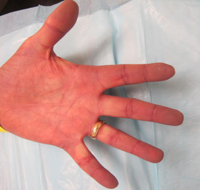 Raynaud's stage 3 increased blood flow- red fingers